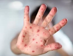 Virus Mpox Juga dapat Menular Melalui Kontak Seksual, Ini Penjelasan Dokter