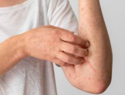 88 Kasus Mpox di Indonesia, Hubungan Seksual Sesama Jenis Jadi Salah Satu Penyebab