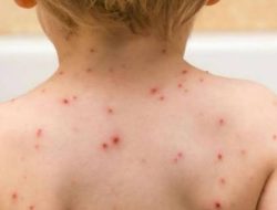 WHO Sebut Anak-anak Kekurangan Gizi Rentan Tertular Monkeypox