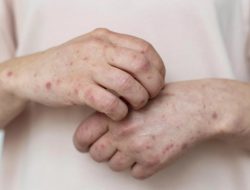 Kemenkes Bantah Narasi di Media Sosial Mpox Dipicu Efek Samping Vaksin Covid-19