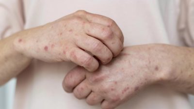 Kemenkes Bantah Narasi di Media Sosial Mpox Dipicu Efek Samping Vaksin Covid-19