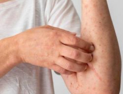 Dinkes Tangsel Temukan 5 Kasus Mpox, Warga Diminta Tidak Panik dan Tingkatkan PHBS