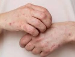 Benarkah Terinfeksi Positif Mpox Hanya Perlu Istirahat? Ini Penjelasan Kemenkes