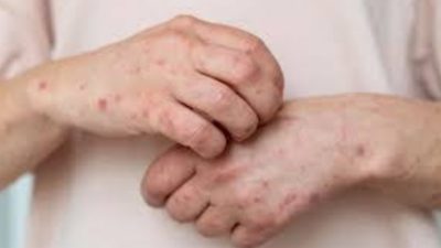 Benarkah Terinfeksi Positif Mpox Hanya Perlu Istirahat? Ini Penjelasan Kemenkes