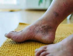 Waspada Diabetic Foot Jika Luka di Kaki Tak Kunjung Sembuh, Apa itu?