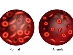 Padahal Diberi ASI Sampai 6 Bulan, Kenapa Anak Mengalami Anemia Defisiensi Besi?
