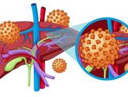 28 Juli Hari Hepatitis Sedunia: Let’s Break It Down