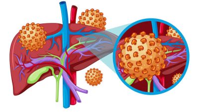 28 Juli Hari Hepatitis Sedunia: Let’s Break It Down
