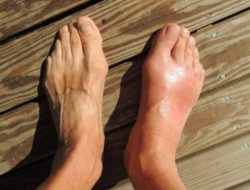 Jalani Pola Hidup Sehat, Hindari Makanan Ini Jika Tidak Ingin Alami Asam Urat