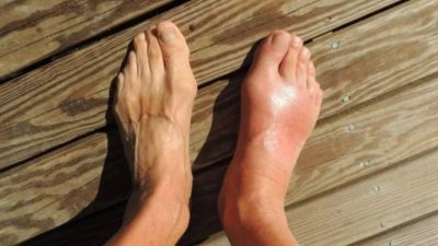 Jalani Pola Hidup Sehat, Hindari Makanan Ini Jika Tidak Ingin Alami Asam Urat