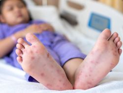 Gawat! Campak Lagi ‘Nge-gas’ di RI, Penularannya Ternyata Lebih Ngeri dari COVID-19