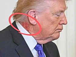 Ruam di Lehernya Viral di Media Sosial, Ini Penyakit yang Diderita Donald Trump