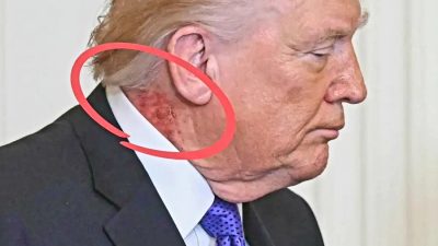 Ruam di Lehernya Viral di Media Sosial, Ini Penyakit yang Diderita Donald Trump