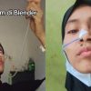 Viral! Gadis Tasikmalaya Idap Penyakit 1 Banding 100 Ribu, Makan Hanya Bisa Lewat Selang