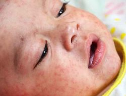 Cirebon Darurat Campak! Status KLB Ditetapkan Usai Dua Nyawa Pasien Melayang