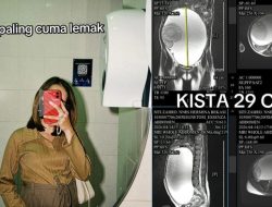 Perut Membesar Dikira Lemak Bakso dan Seblak, Wanita Ini Ternyata Miliki Kista Berukuran 29 Cm