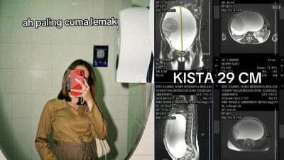 Perut Membesar Dikira Lemak Bakso dan Seblak, Wanita Ini Ternyata Miliki Kista Berukuran 29 Cm